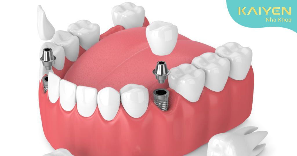 Công nghệ Implant 4s phù hợp với nhiều đối tượng mất răng