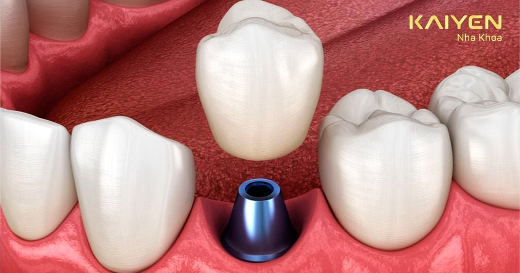 Khớp nối Abutment và răng sứ được bảo hành trong 2 năm đầu