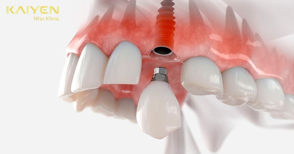 Trồng răng Implant thực hiện đôc lập tại vị trí mất răng