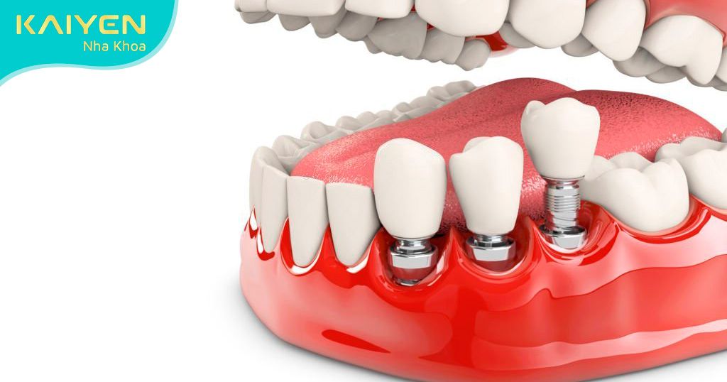 Trồng răng Implant bao lâu lành thương cần tới 2-6 tháng