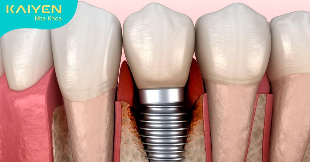 [Cảnh giác] Trồng răng Implant bị nhiễm trùng và biến chứng nguy hiểm