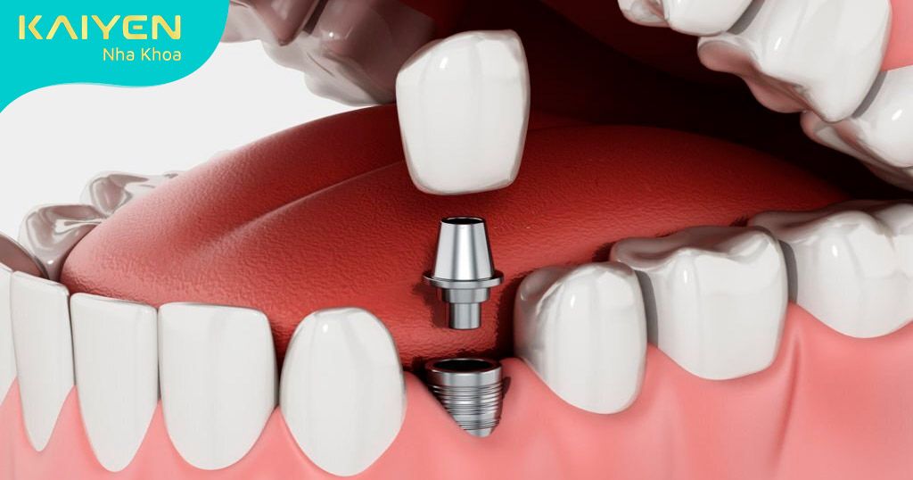 Cấy ghép Implant – phương pháp trồng răng tân tiến bậc nhất