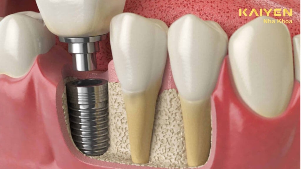 trồng răng implant cho người già