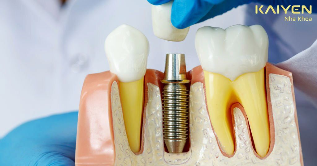 Trồng răng Implant cho người lớn tuổi