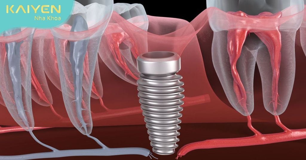 Trồng răng Implant cho trẻ em gây ra những ảnh hưởng xấu