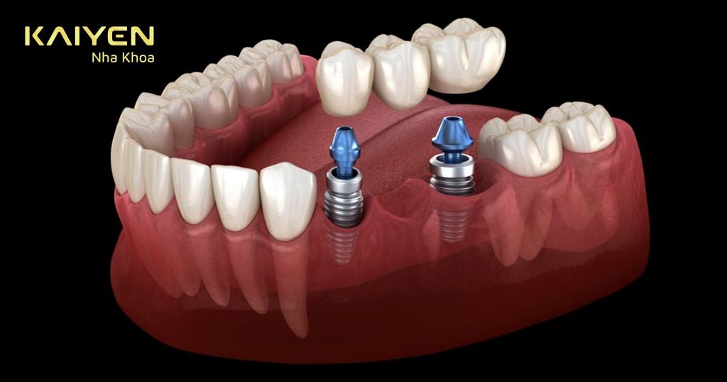 Cấy ghép Implant giúp phục hồi cả chân răng và thân răng