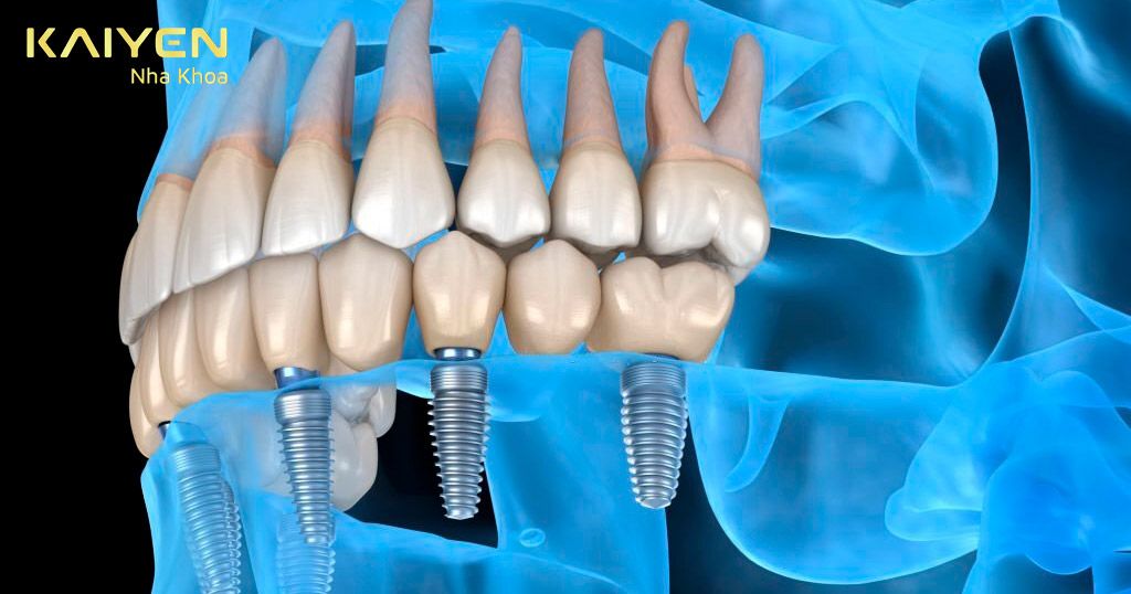 Cấy ghép răng Implant Có Đau không? 4 Bước giảm đau hiệu quả