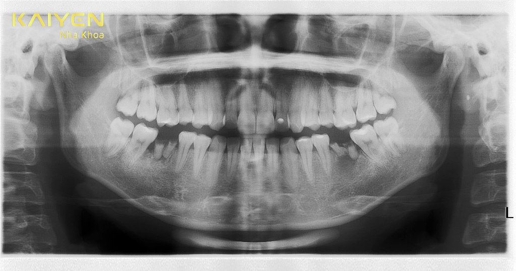 Kiểm tra tình trạng răng miệng bằng Chụp X-quang CT 3D