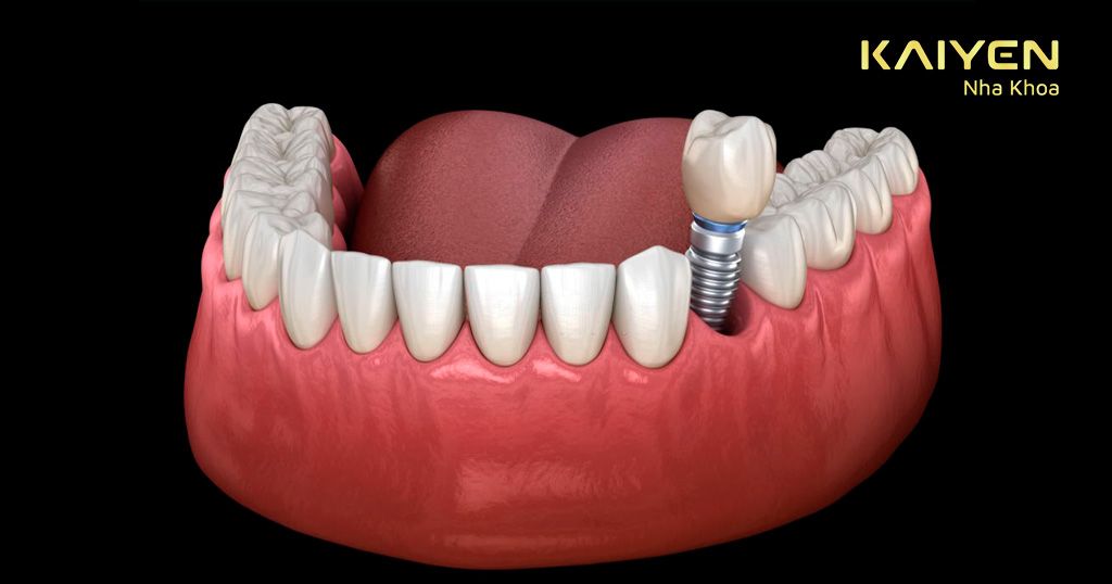 Trồng răng Implant không nằm trong danh sách chi trả của bảo hiểm y tế