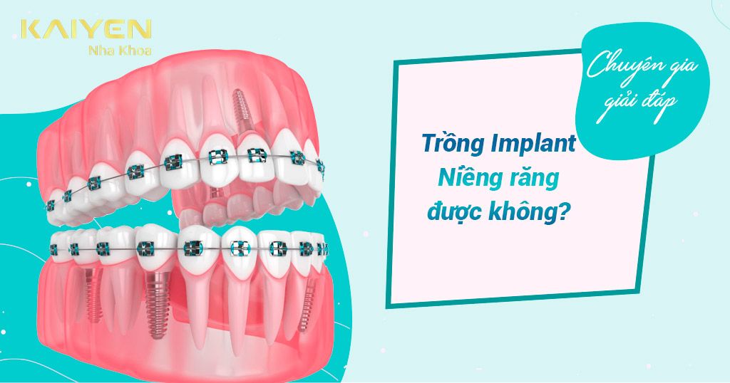 Trồng Implant có niềng răng được không? Chuyên gia giải đáp