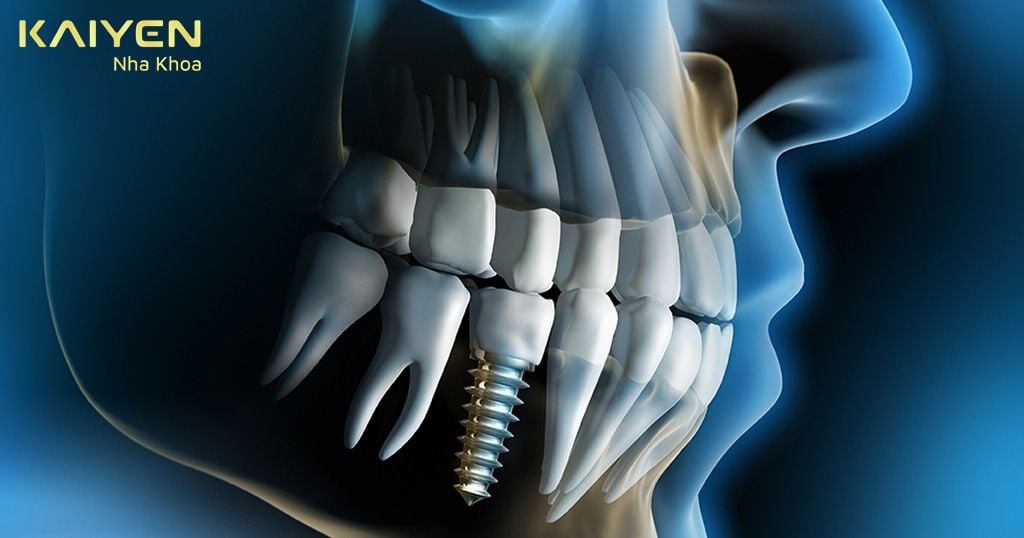 Răng Implant tồn tại được bao lâu? – Từ 20 năm đến trọn đời