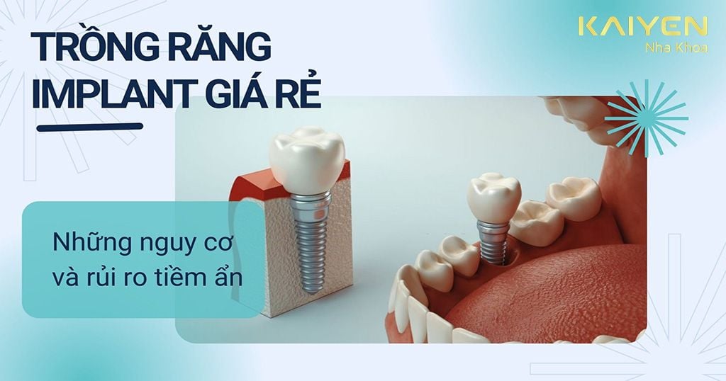 Trồng răng Implant giá rẻ và những nguy cơ và rủi ro tiềm ẩn