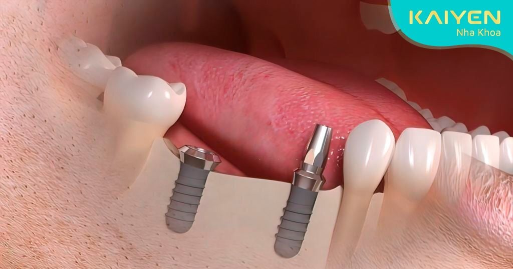 Trồng răng giá rẻ do trụ Implant không đảm bảo