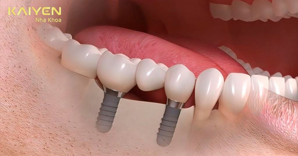 Răng không khỏe mạnh sau cấy ghép Implant