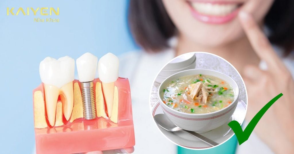 Nên ăn sau cấy ghép răng Implant