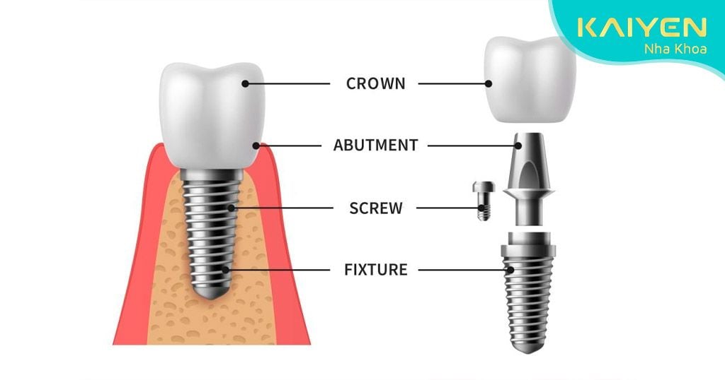 Răng Implant có cấu tạo gồm 3 phần tương tự răng thật