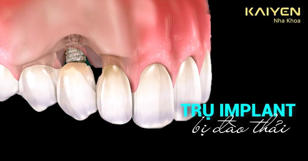 Trụ Implant bị đào thải do một số sai sót trong điều trị