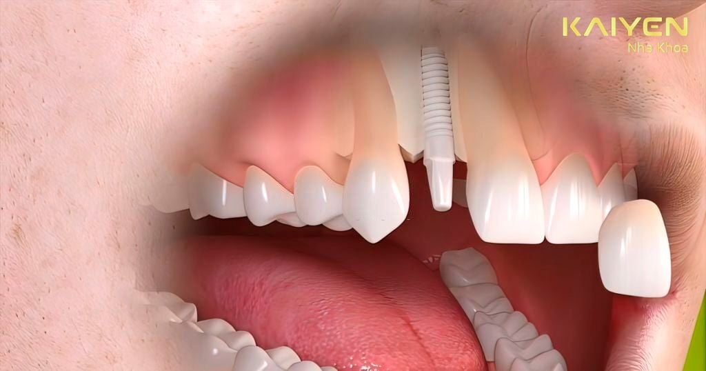 Trụ răng Implant không vững chắc, lung lay