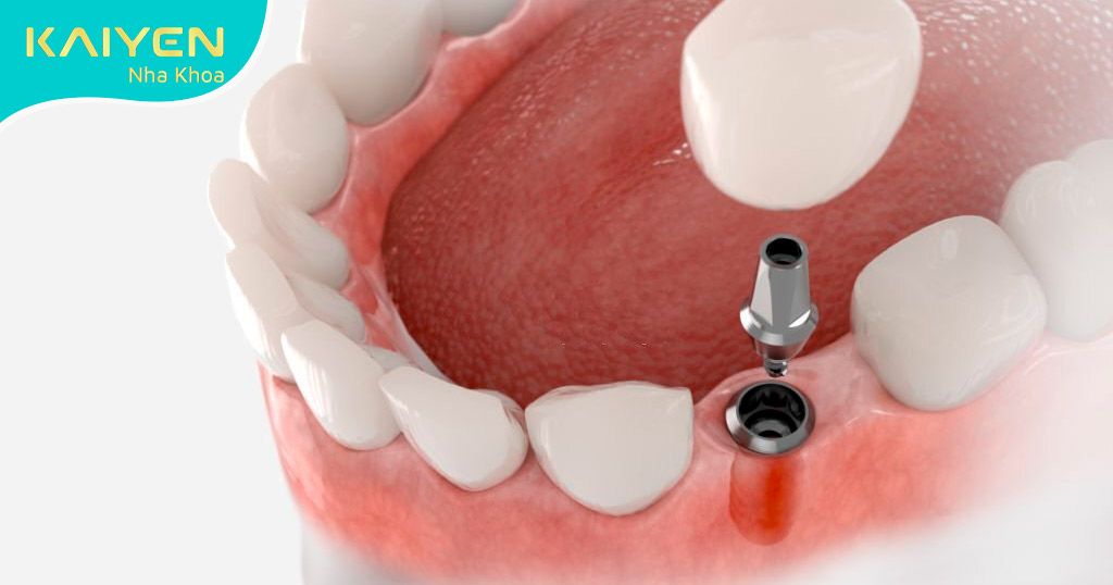 Thời Gian trồng răng Implant mất bao lâu? Các yếu tố quyết định