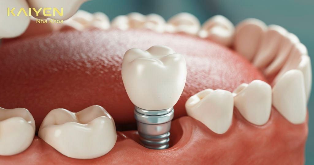 bệnh nhân phải đợi từ 4 – 6 tháng để trụ Implant tích hợp với xương hàm