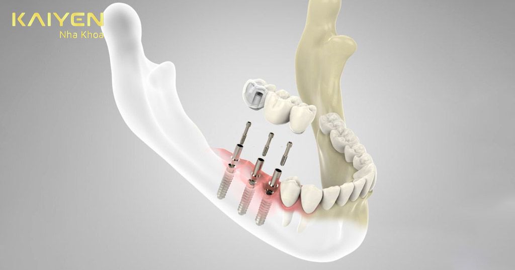 Sau khi ghép xương bao lâu có thể cấy implant?