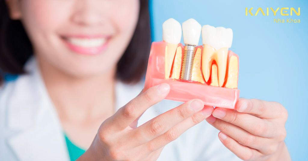 Trồng răng Implant có được ăn nhai thoải mái không?