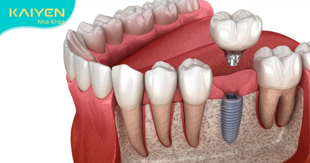 Trồng răng Implant số 6