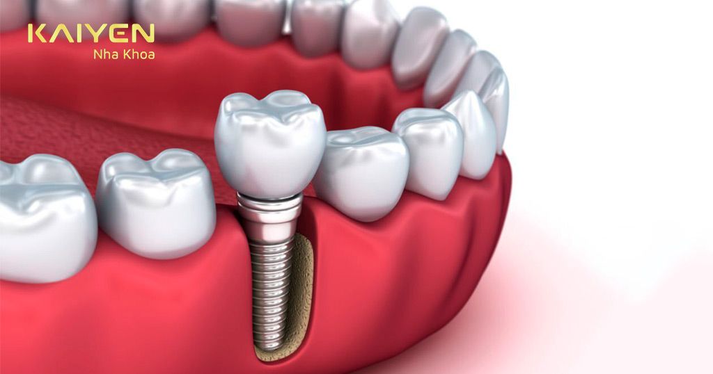 Trồng răng Implant là giải pháp tốt nhất để phục hình răng mất