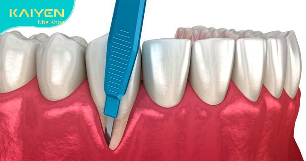 Trồng răng Implant số 6 giúp ngăn chặn tình trạng tụt lợi