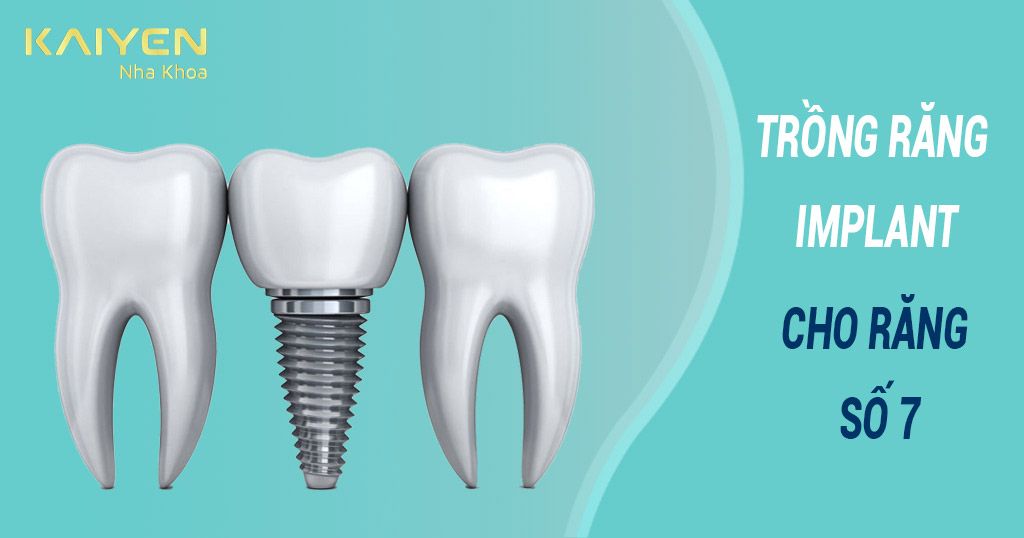 Trồng răng Implant số 7 có tốt không?
