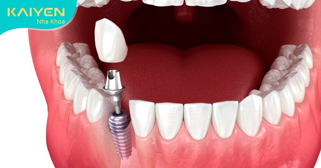 Răng Implant cấu tạo tương tự răng thật sở hữu nhiều ưu điểm vượt trội
