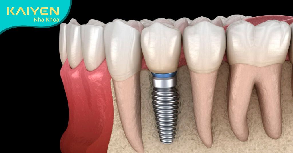 Trụ Implant tích hợp bền vững trong xương hàm