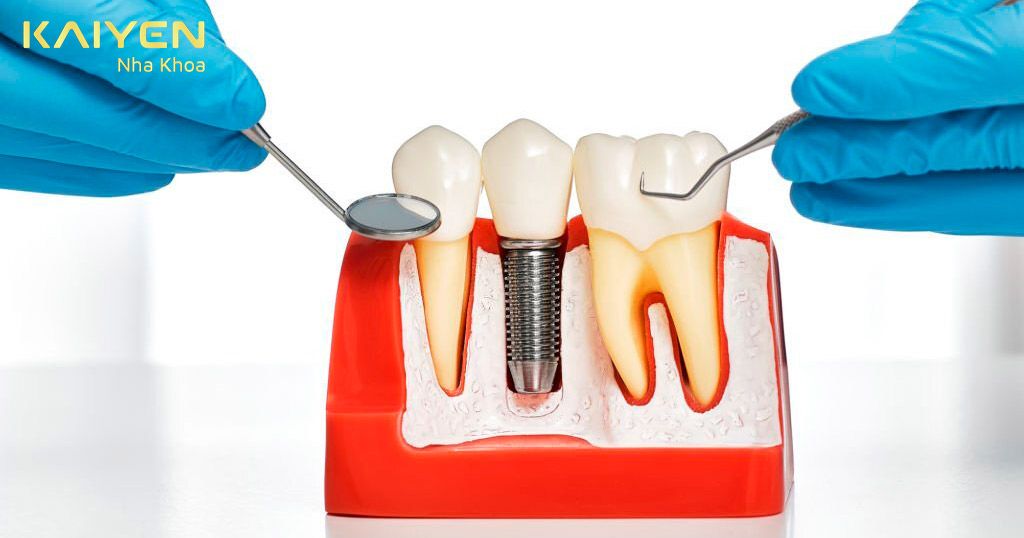 Trồng răng Implant trả góp uy tín nhất TP.HCM – Nha Khoa KAIYEN