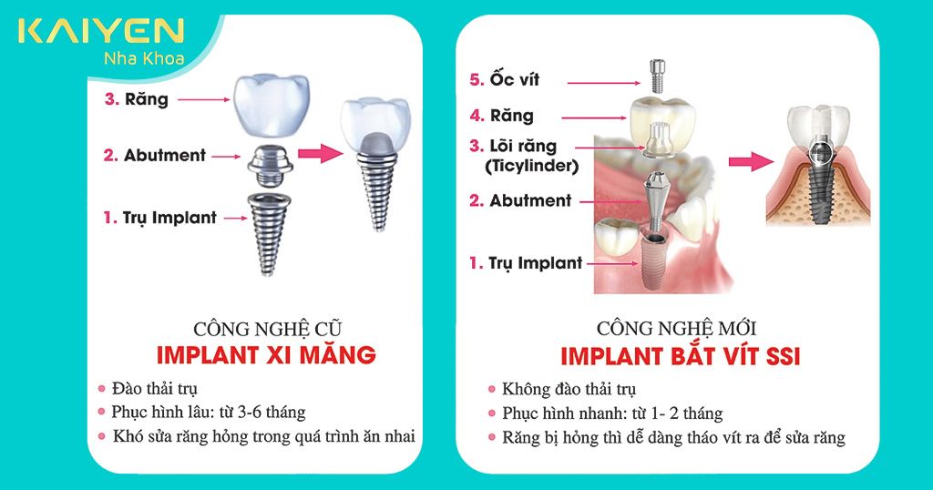 So sánh ưu nhược điểm chi tiết của trồng răng Implant xi măng và bắt vít