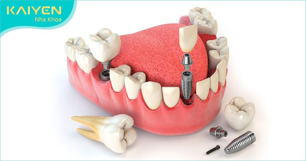 Trồng răng Implant bắt vít (Implant SSI)