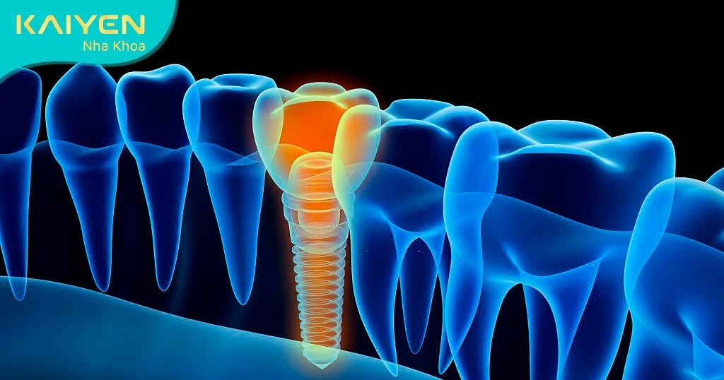 Trồng Implant xi măng dễ gây viêm nhiễm, tiêu xương