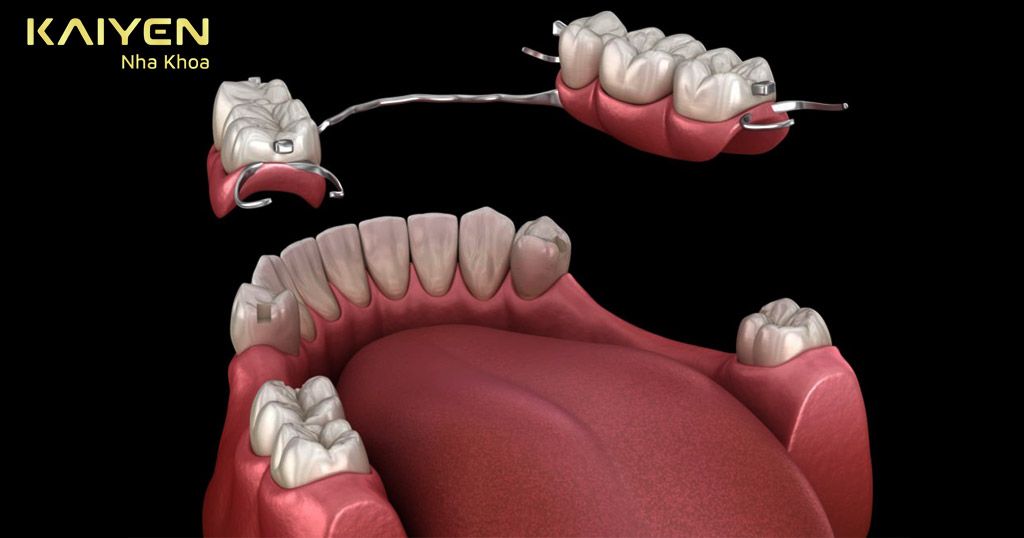 Trồng răng bằng phương pháp dùng hàm giả tháo lắp bán phần