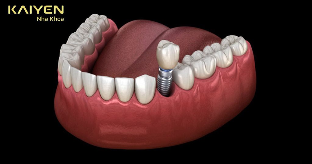 Trồng răng mất bao lâu với giải pháp cấy ghép Implant?