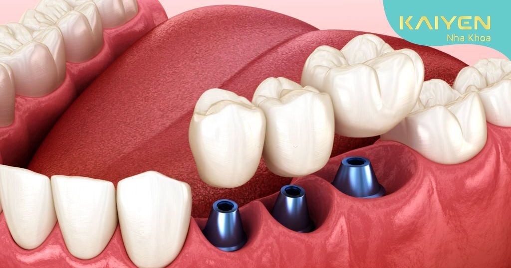 Cấy ghép Implant là phương pháp trồng răng giả tối ưu nhất