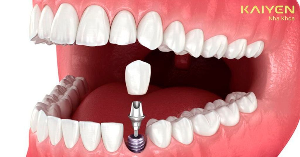 Những tác hại nghiêm trọng khi người bệnh không thực hiện trồng răng
