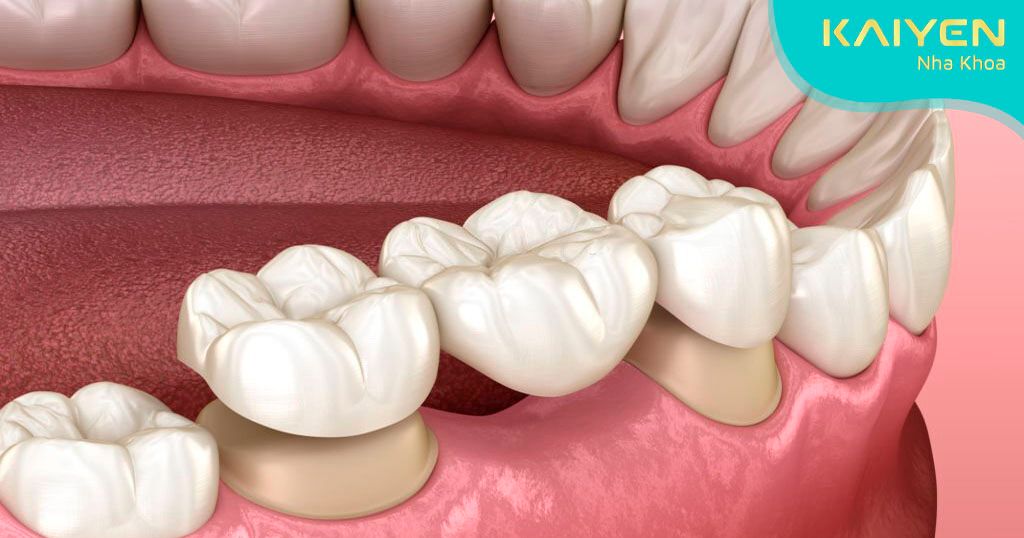 Phương pháp cầu răng sứ còn nhiều hạn chế
