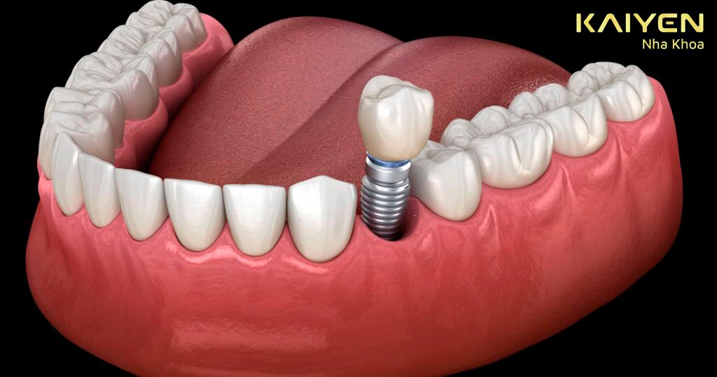 Áp dụng trồng răng sứ bằng phương pháp cấy ghép Implant vô cùng hiệu quả