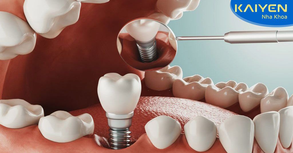 Trồng răng số 5 phương pháp nào tốt nhất? Giá bao nhiêu?