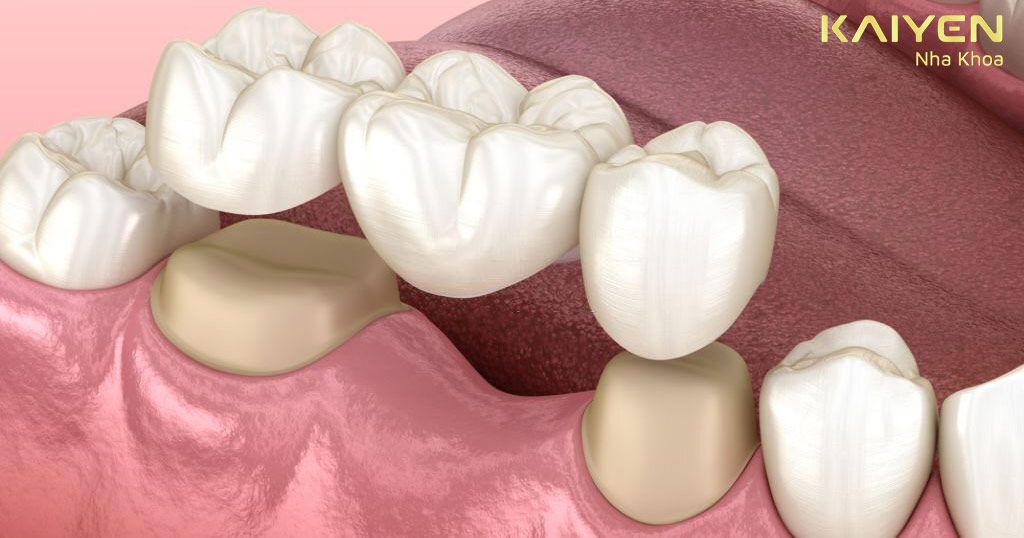 Cầu răng sứ bằng cách mài hai răng kế cận là răng số 4 và số 6 để làm trụ nâng đỡ