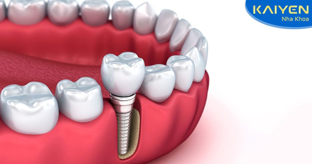 Trồng răng số 5 bằng phương pháp cấy ghép Implant
