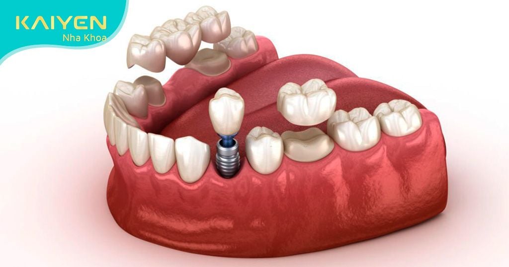 Hiện nay có những cách trồng răng sứ phổ biến nào?