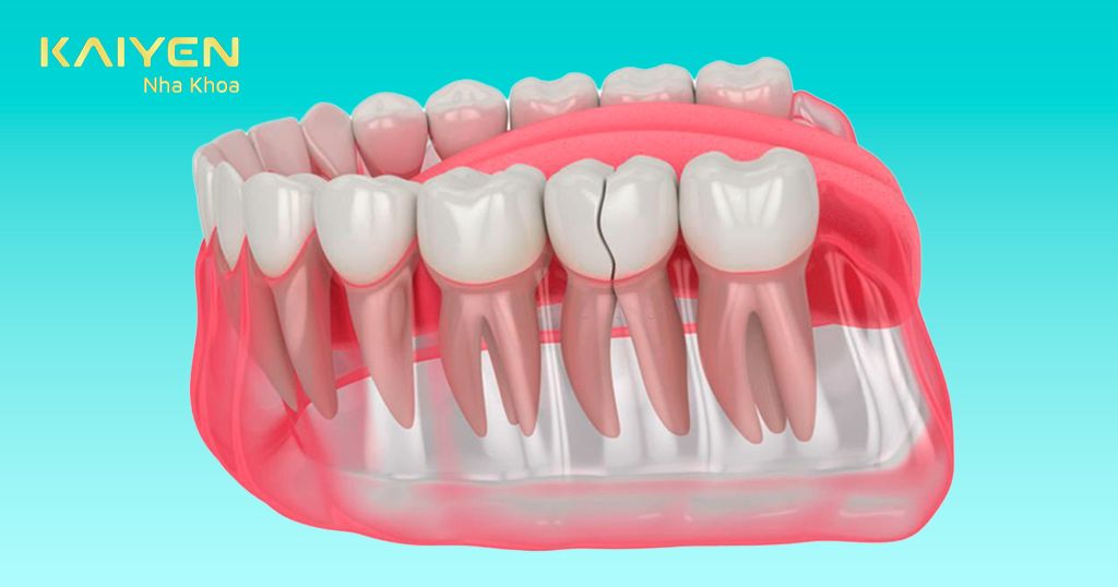 Nên trồng răng sứ khi bị mất răng 1 chiếc hoặc toàn hàm
