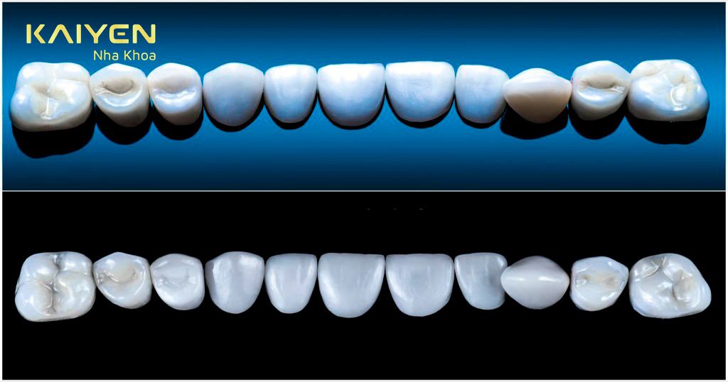 Vật liệu sứ được chọn có thể ảnh hưởng đến chi phí trồng răng
