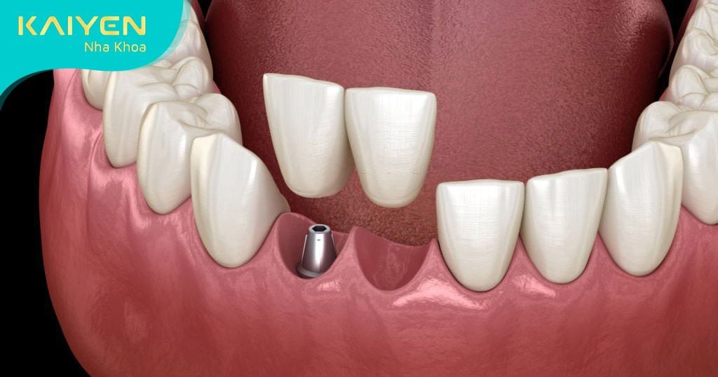 Trường hợp nên trồng răng Implant