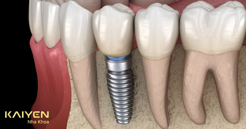 Cấy ghép Implant phục hình răng sứ mất chân răng